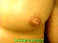 Doctor Ronald Friedman, MD, Plano Plastic Surgeon - Male Nipple Reduction Before And After (2)