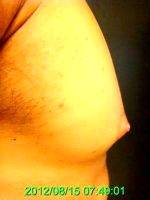 Doctor Ronald Friedman, MD, Plano Plastic Surgeon - Male Nipple Reduction Before And After (3)