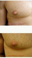 Doctor Ronald Friedman, MD, Plano Plastic Surgeon - Male Nipple Reduction Before And After (4)