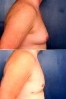Doctor Ronald Schuster, MD, Baltimore Plastic Surgeon Gynecomastia Correction With Periareolar Reduction