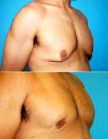 Doctor S. Daniel Golshani, MD, FACS, Beverly Hills Plastic Surgeon 18-24 Year Old Man Treated With Male Breast Reduction