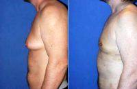 Doctor Sam Gershenbaum, DO, Aventura Plastic Surgeon Gynecomastia (Male Breast Reduction)