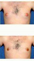 Doctor Samuel N. Pearl, MD, San Jose Plastic Surgeon Male Breast Reduction (Gynecomastia)