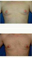 Doctor Samuel N. Pearl, MD, San Jose Plastic Surgeon Male Breast Reduction (Gynecomastia)