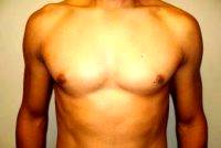 Doctor Sanjay Grover, MD, Orange County Plastic Surgeon - Male Nipple Reduction Before And After (1)