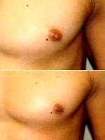 Doctor Sanjay Grover, MD, Orange County Plastic Surgeon - Male Nipple Reduction Before And After (2)