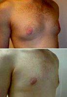 Doctor Scott A. Brenman, MD, FACS, Philadelphia Plastic Surgeon Male Breast Reduction