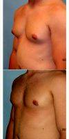 Doctor Sean T. Lille, MD, Scottsdale Plastic Surgeon 25-34 Year Old Man Treated With Male Breast Reduction