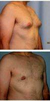 Doctor Sean T. Lille, MD, Scottsdale Plastic Surgeon 40 Year Old Man Treated With Male Breast Reduction