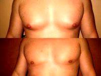 Doctor Sherwood Baxt, MD, Paramus Plastic Surgeon Liposuction For Gynecomastia ( Male Breast Reduction) Photos (1)