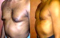 Doctor Sherwood Baxt, MD, Paramus Plastic Surgeon Liposuction For Gynecomastia ( Male Breast Reduction) Photos (2)