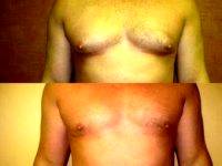 Doctor Sherwood Baxt, MD, Paramus Plastic Surgeon Liposuction For Gynecomastia ( Male Breast Reduction) Photos (3)