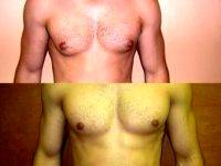 Doctor Sherwood Baxt, MD, Paramus Plastic Surgeon Liposuction For Male Breast Reduction Gynecomastia