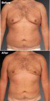 Doctor Steven Teitelbaum, MD, Los Angeles Plastic Surgeon Male Breast Reduction