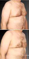 Doctor Steven Teitelbaum, MD, Los Angeles Plastic Surgeon Male Breast Reduction