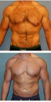 Doctor Susan D. Vasko, MD, FACS, Columbus Plastic Surgeon 39 Year Old Man Treated With Male Breast Reduction