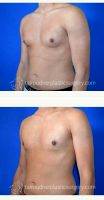 Doctor Tal T. Roudner, MD, FACS, Miami Plastic Surgeon 25 Year Old Man Treated With Male Breast Reduction