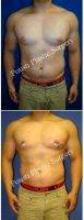 Doctor Tom J. Pousti, MD, FACS, San Diego Plastic Surgeon 24 Year Old Man Treated With Male Breast Reduction