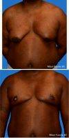 Doctor William Franckle, MD, FACS, Voorhees Plastic Surgeon Male Breast Reduction
