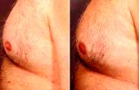 Doctor William Koenig, MD, Rochester Plastic Surgeon - 55 Year Old Male Before And After (1)