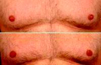 Doctor William Koenig, MD, Rochester Plastic Surgeon - 55 Year Old Male Before And After (2)