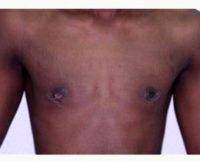 Doctor Zoran Potparic, MD, Fort Lauderdale Plastic Surgeon 15 Year Old Man Treated For Gynecomastia With Breast Gland Removal, Breast Reduction