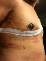 Does Gynecomastia Surgery Leave Scars