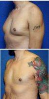 Dr Aaron J. Mayberry, MD, FACS, Albuquerque Plastic Surgeon Male Breast Reduction Before And After