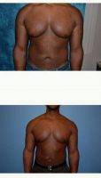 Dr Alan N. Larsen, MD, Atlanta Plastic Surgeon Male Breast Reduction