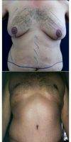 Dr Alex Campbell, MD, Colombia Plastic Surgeon 41 Year Old Man Treated With Male Breast Reduction