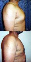 Dr Allen Rezai, MD, London Plastic Surgeon 35-44 Year Old Man Treated With Male Breast Reduction