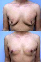 Dr Amy T. Bandy, DO, FACS, Newport Beach Plastic Surgeon Male Breast Reduction