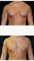 Dr Andrew M. Lofman, MD, FACS, Detroit Plastic Surgeon 18-24 Year Old Man Treated With Male Breast Reduction