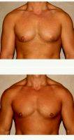 Dr Babak Dadvand, MD, Los Angeles Plastic Surgeon 28 Year Old Man Treated With Male Breast Reduction