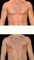Dr Brian Vassar Heil, MD, Pittsburgh Plastic Surgeon Male Breast Reduction Before After