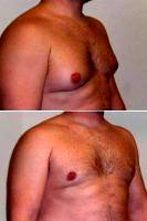 Dr Carmen Kavali, MD, Atlanta Plastic Surgeon Male Breast Reduction