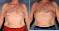 Dr Christa Clark, MD, FACS, Sacramento Plastic Surgeon Liposuction, Male Breast Reduction Before And AFter (2)