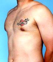 Dr Dan Mills, MD, Orange County Plastic Surgeon 26 Year Old Male Treated With Liposuction For Gynecomastia (2)