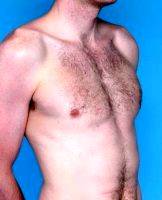 Dr Dan Mills, MD, Orange County Plastic Surgeon 29 Year Old Male Treated For Gynecomastia With Liposuction (1)