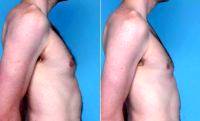 Dr Dan Mills, MD, Orange County Plastic Surgeon 29 Year Old Male Treated For Gynecomastia With Liposuction (2)