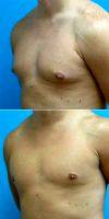 Dr David J. Levens, MD, Coral Springs Plastic Surgeon 25-34 Year Old Man Treated With Male Breast Reduction