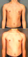 Dr Ellen A. Janetzke, MD, Bloomfield Hills Plastic Surgeon 17 Or Under Year Old Man Treated With Male Breast Reduction