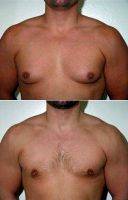 Dr Elliot W. Jacobs, MD, New York Plastic Surgeon Adult Male Treated For Breast Reduction