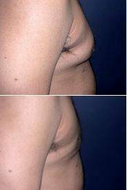Dr George Lefkovits, MD - , New York Plastic Surgeon Male Breast Reduction Surgery