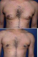 Dr George Lefkovits, MD - New York Plastic Surgeon Male Breast Reduction Surgery