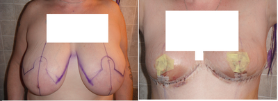 Dr H. Ukani Getting A Breast Reduction Before And After