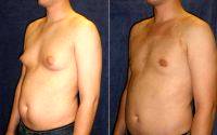 Dr James A. Hoffman, MD, Saint Paul Plastic Surgeon Male Breast Reduction