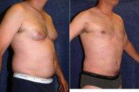 Dr James A. Hoffman, MD, Saint Paul Plastic Surgeon Male Breast Reduction - Gynecomastia