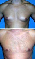 Dr James McMahan, MD, Columbus Plastic Surgeon 27 Year Old Male Treated For Gynecomastia