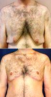Dr Jason S. Cooper, MD, Jupiter Plastic Surgeon Male Breast Reduction (Gynecomastia)